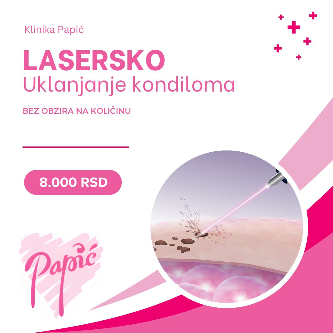 Lasersko uklanjanje kondiloma